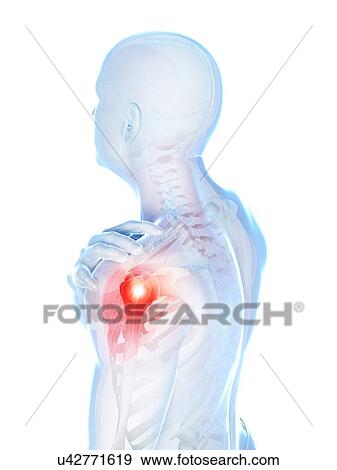Stock Illustration - Painful shoulder, artwork. Fotosearch