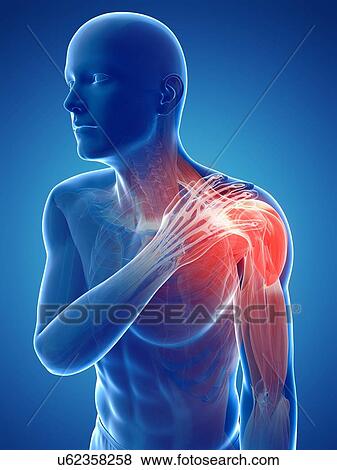 Stock Illustration - Painful shoulder, artwork. Fotosearch