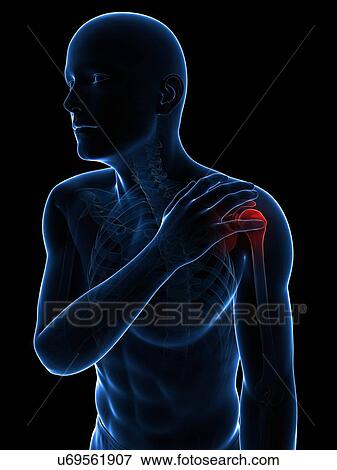 Painful shoulder, artwork View Large Illustration Stock Illustration - Painful shoulder, artwork. Fotosearch