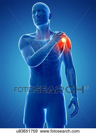 Stock Illustration - Painful shoulder, artwork. Fotosearch