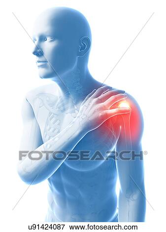 Painful shoulder, artwork View Large Illustration Stock Illustration - Painful shoulder, artwork. Fotosearch