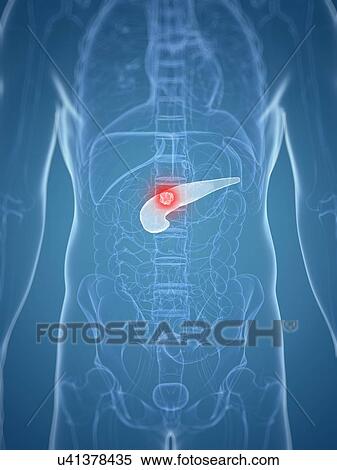 Pancreatic cancer, artwork View Large Illustration Stock Illustration - Pancreatic cancer, artwork. Fotosearch