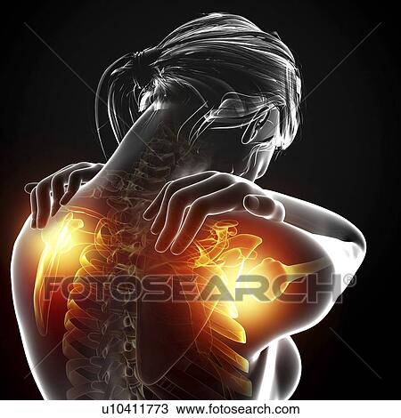 Shoulder pain, artwork Drawing | u10411773 | Fotosearch