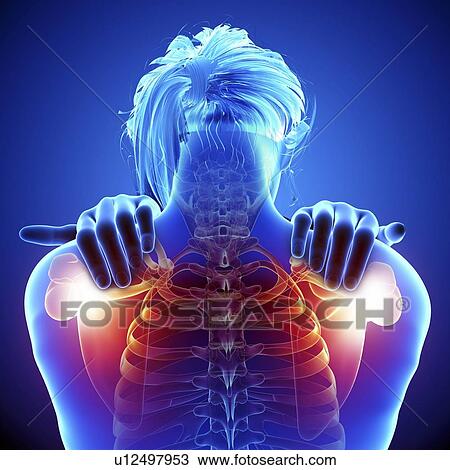 Shoulder pain, artwork Drawing | u12497953 | Fotosearch