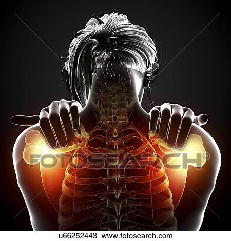 Shoulder pain, artwork Drawing | u66252443 | Fotosearch