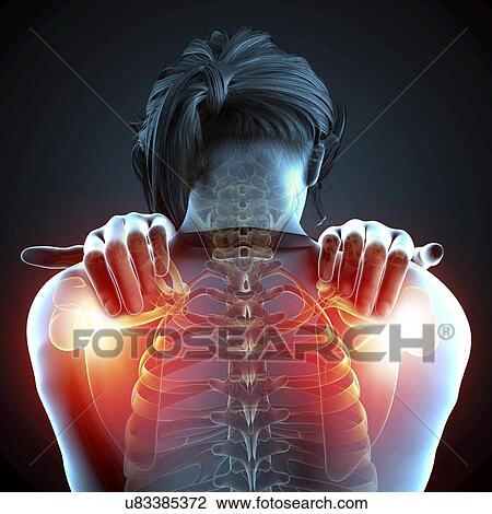 Drawing - Shoulder pain, artwork. Fotosearch