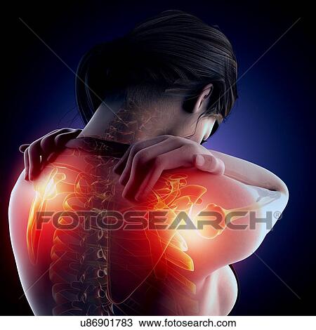 Shoulder pain, artwork Drawing | u86901783 | Fotosearch