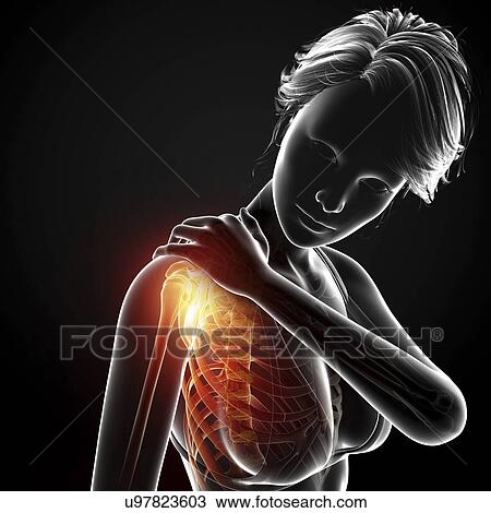 Shoulder pain, artwork Drawing | u97823603 | Fotosearch