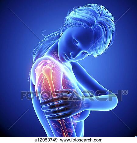 Stock Illustration - Shoulder pain, artwork. Fotosearch