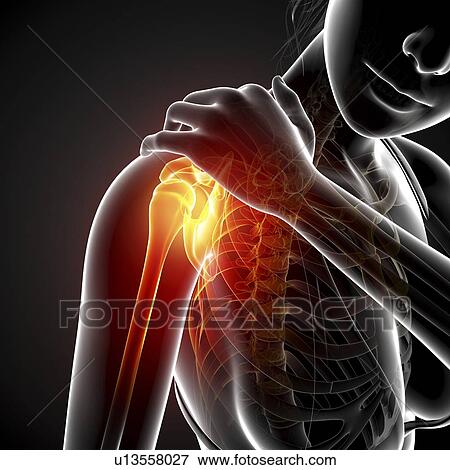 Stock Illustration - Shoulder pain, artwork. Fotosearch