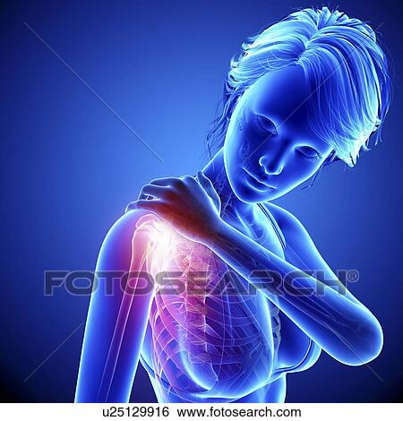 Stock Illustration - Shoulder pain, artwork. Fotosearch