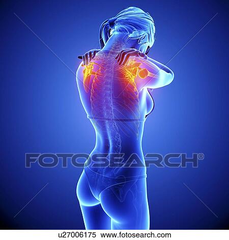 Stock Illustration - Shoulder pain, artwork. Fotosearch