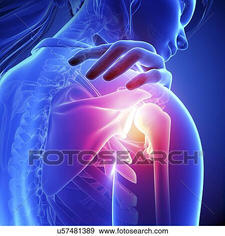 Shoulder pain, artwork View Large Illustration Stock Illustration - Shoulder pain, artwork. Fotosearch