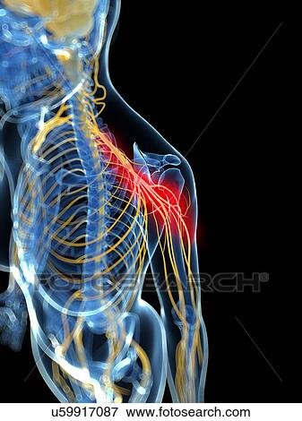 Shoulder pain, artwork View Large Illustration Stock Illustration - Shoulder pain, artwork. Fotosearch