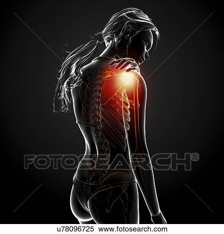 Shoulder pain, artwork View Large Illustration Stock Illustration - Shoulder pain, artwork. Fotosearch