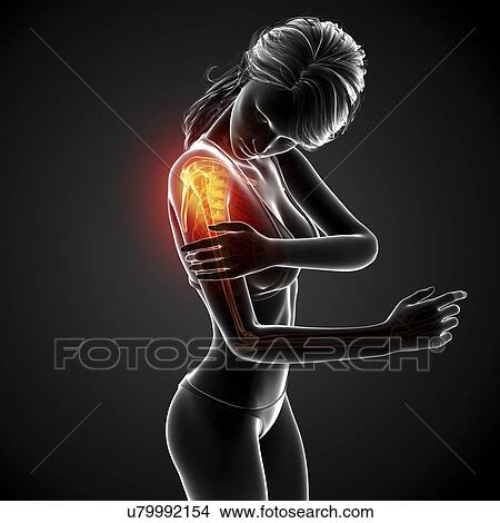 Stock Illustration - Shoulder pain, artwork. Fotosearch