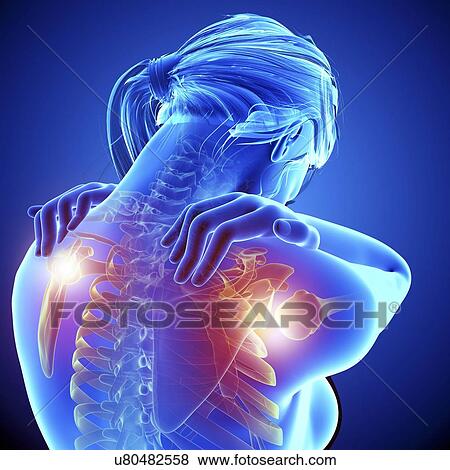 Stock Illustration - Shoulder pain, artwork. Fotosearch