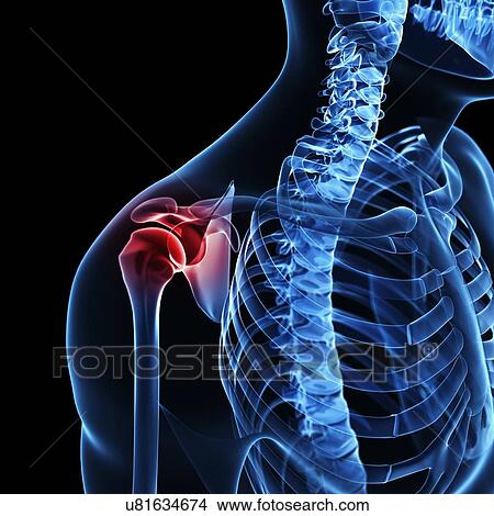 Stock Illustration - Shoulder pain, artwork. Fotosearch
