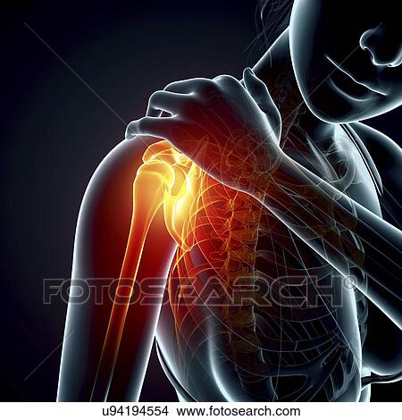Shoulder pain, artwork View Large Illustration Stock Illustration - Shoulder pain, artwork. Fotosearch