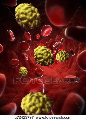 Stock Illustration - Small Pox, artwork. Fotosearch