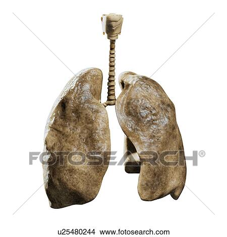 Smoker's lungs, artwork View Large Illustration Stock Illustration - Smoker's lungs, artwork. Fotosearch