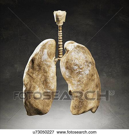 Smoker's lungs, artwork View Large Illustration Stock Illustration - Smoker's lungs, artwork. Fotosearch