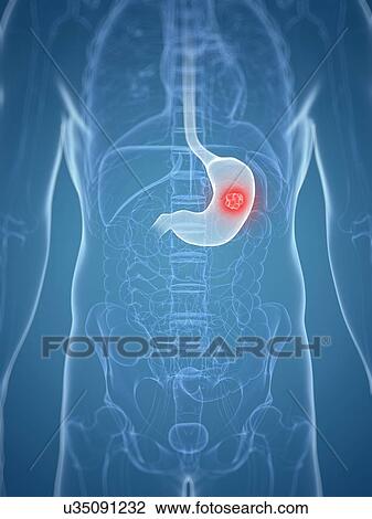 Stomach pain, artwork View Large Illustration Drawing - Stomach pain, artwork. Fotosearch
