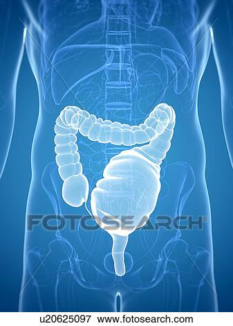 Toxic megacolon, artwork View Large Illustration Stock Illustration - Toxic megacolon, artwork. Fotosearch