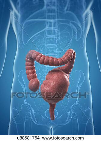 Toxic megacolon, artwork View Large Illustration Stock Illustration - Toxic megacolon, artwork. Fotosearch