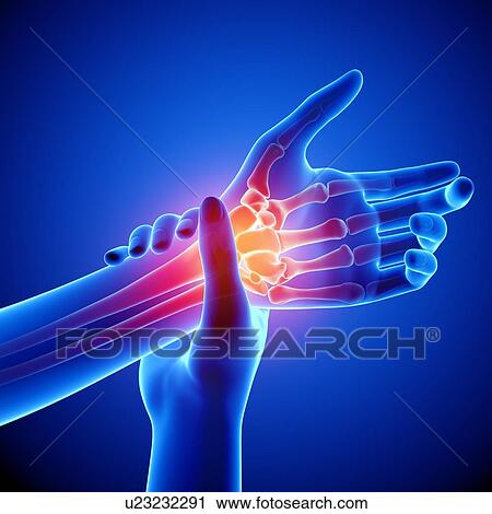 Clip Art - Wrist pain, artwork. Fotosearch