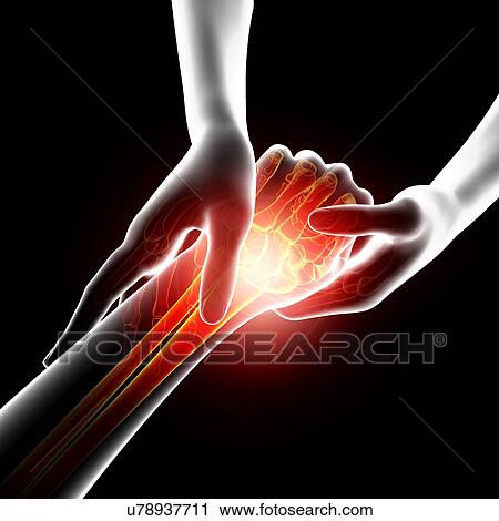Clip Art - Wrist pain, artwork. Fotosearch