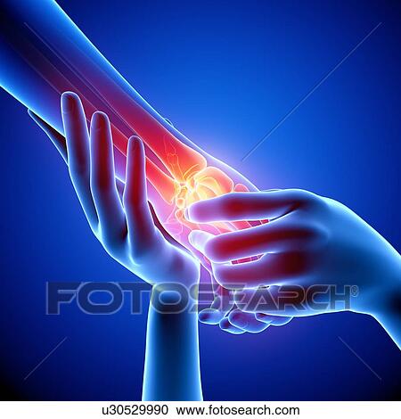 Clipart - Wrist pain, artwork. Fotosearch