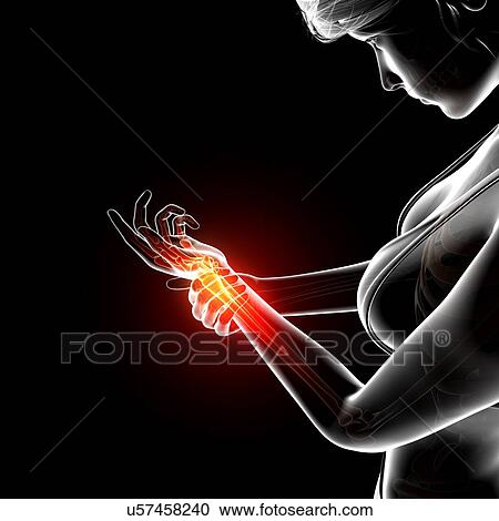 Clipart - Wrist pain, artwork. Fotosearch