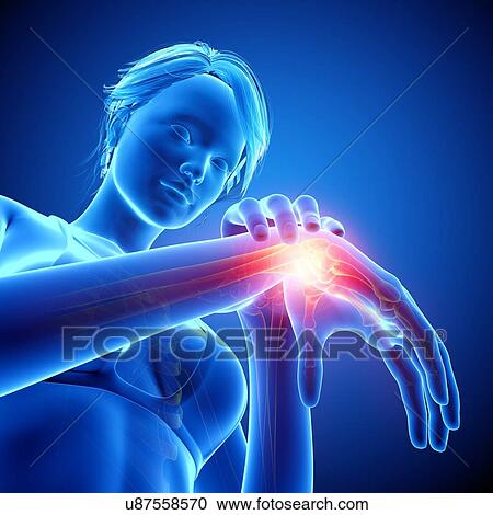 Clipart - Wrist pain, artwork. Fotosearch