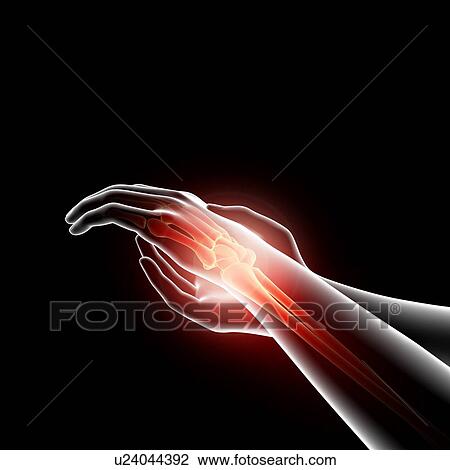 Wrist pain, artwork View Large Illustration Drawing - Wrist pain, artwork. Fotosearch