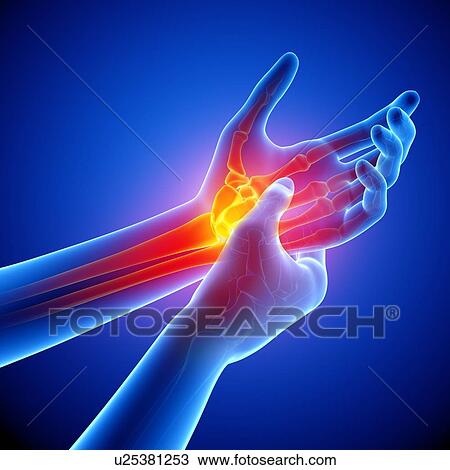 Drawing - Wrist pain, artwork. Fotosearch