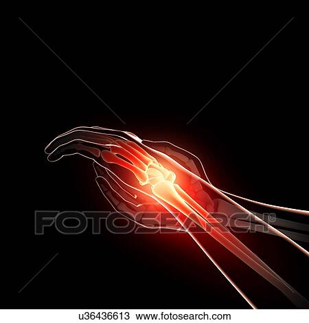 Wrist pain, artwork View Large Illustration Drawing - Wrist pain, artwork. Fotosearch