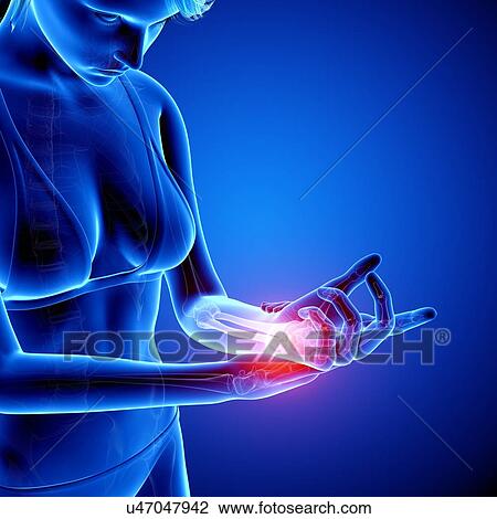 Wrist pain, artwork View Large Illustration Drawing - Wrist pain, artwork. Fotosearch