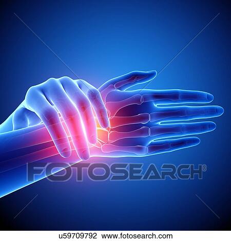 Drawing - Wrist pain, artwork. Fotosearch