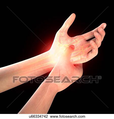 Wrist pain, artwork View Large Illustration Drawing - Wrist pain, artwork. Fotosearch