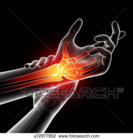 Wrist pain, artwork View Large Illustration Drawing - Wrist pain, artwork. Fotosearch