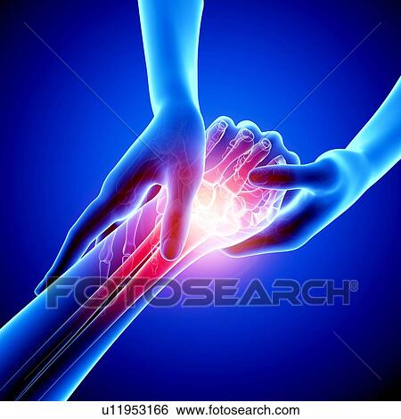 Stock Illustration - Wrist pain, artwork. Fotosearch