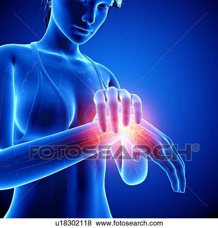 Wrist pain, artwork View Large Illustration Stock Illustration - Wrist pain, artwork. Fotosearch