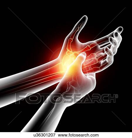 Stock Illustration - Wrist pain, artwork. Fotosearch