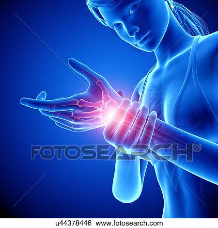 Stock Illustration - Wrist pain, artwork. Fotosearch