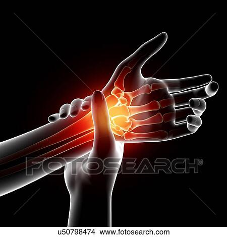 Stock Illustration - Wrist pain, artwork. Fotosearch