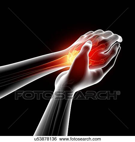Wrist pain, artwork View Large Illustration Stock Illustration - Wrist pain, artwork. Fotosearch
