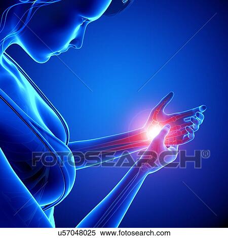 Stock Illustration - Wrist pain, artwork. Fotosearch