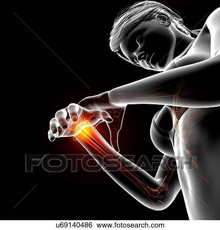 Stock Illustration - Wrist pain, artwork. Fotosearch