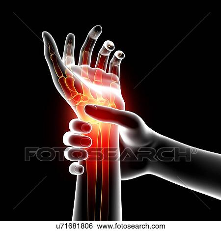 Stock Illustration - Wrist pain, artwork. Fotosearch